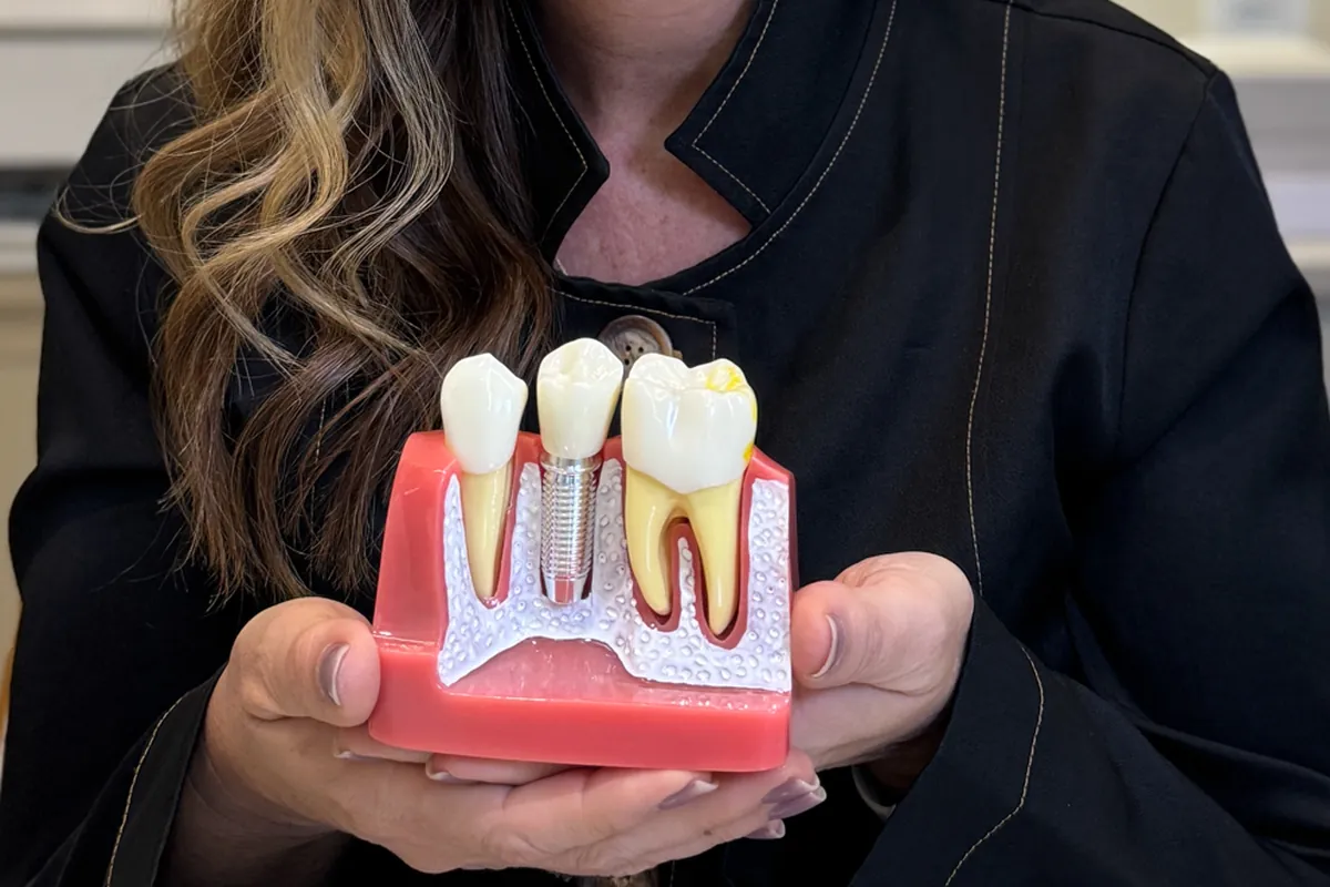 Mãos da dentista segurando um modelo de implante dentário: coroa, pilar e implante de titânio entre dois dentes naturais