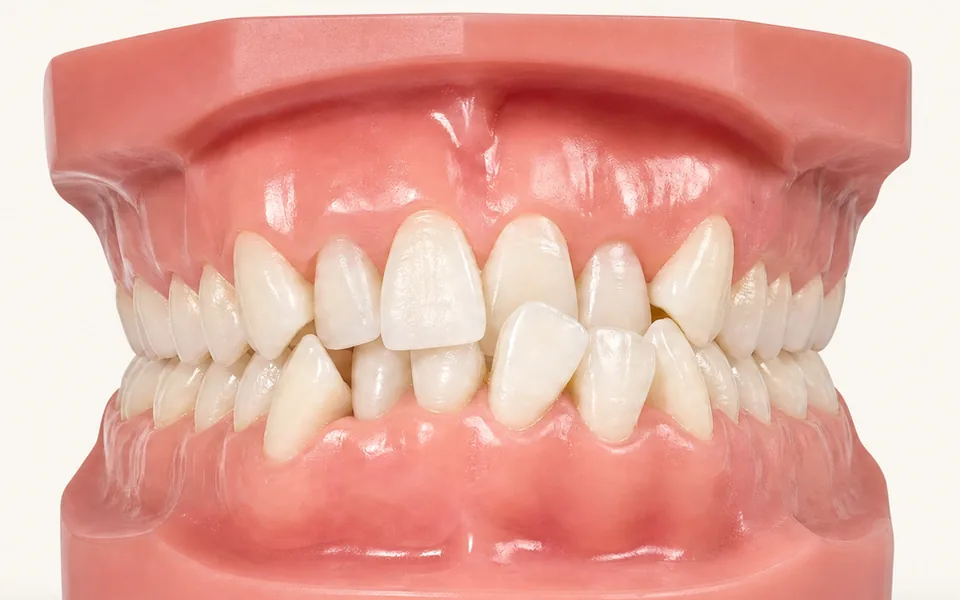 Modelo 3D de arcadas com os dentes da frente encavalados e girados por falta de espaço